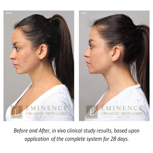 Eminence Organics Acne Advanced Treatment Collection Before and After